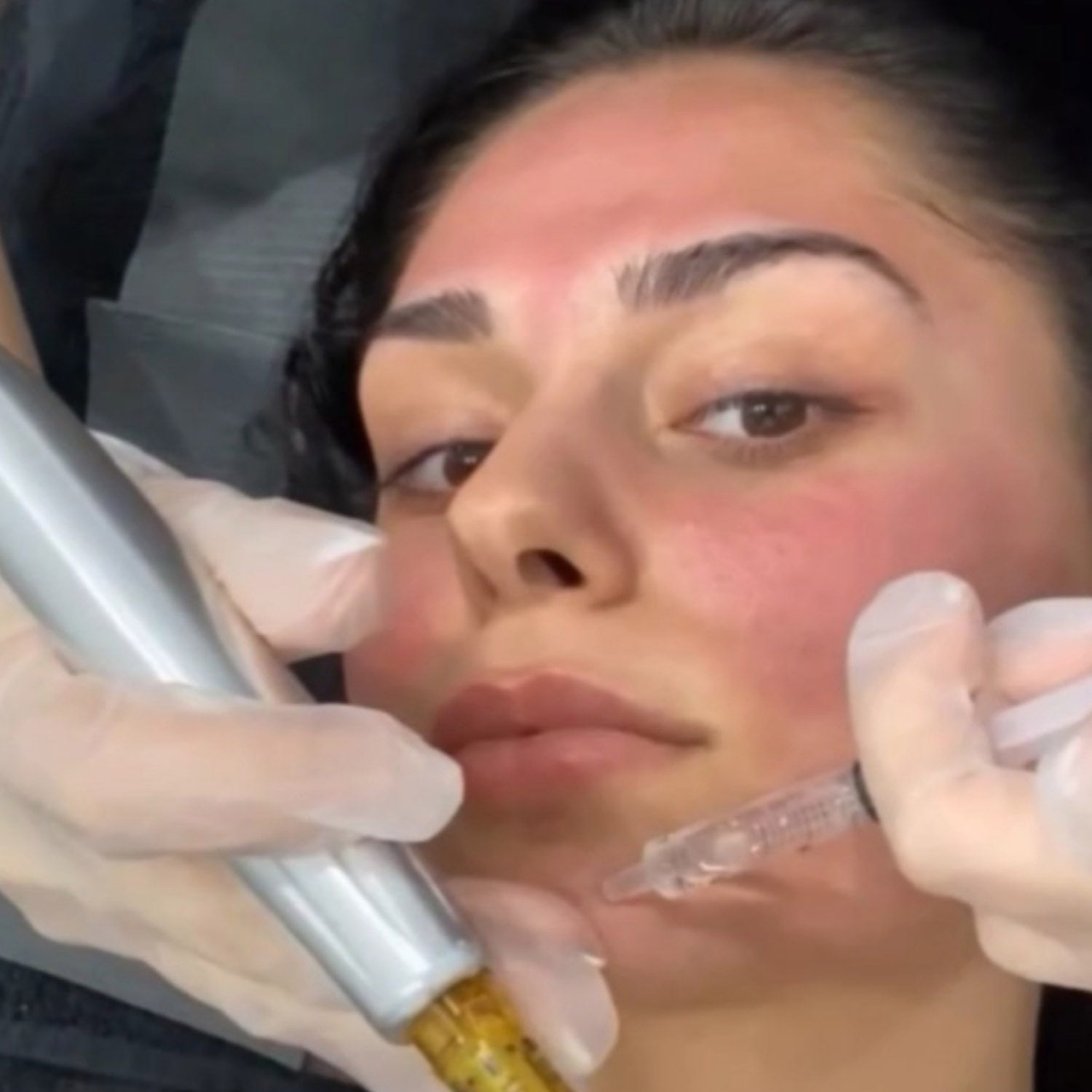 Meso.Prof Ampoule Infusions Treatment at Rejuvenate Laser & Skin Clinic