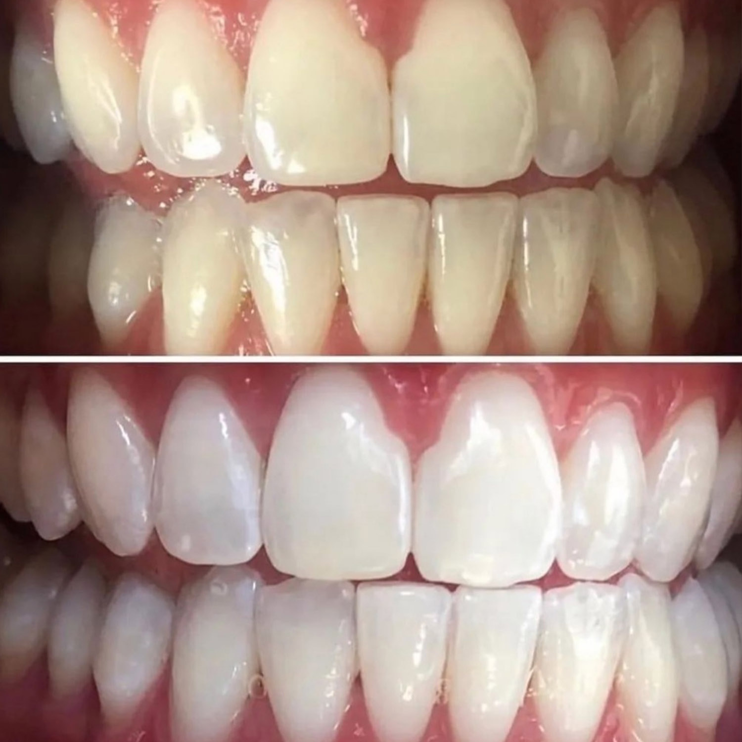 Teeth Whitening Treatment before & After at Rejuvenate Laser & Skin Clinic