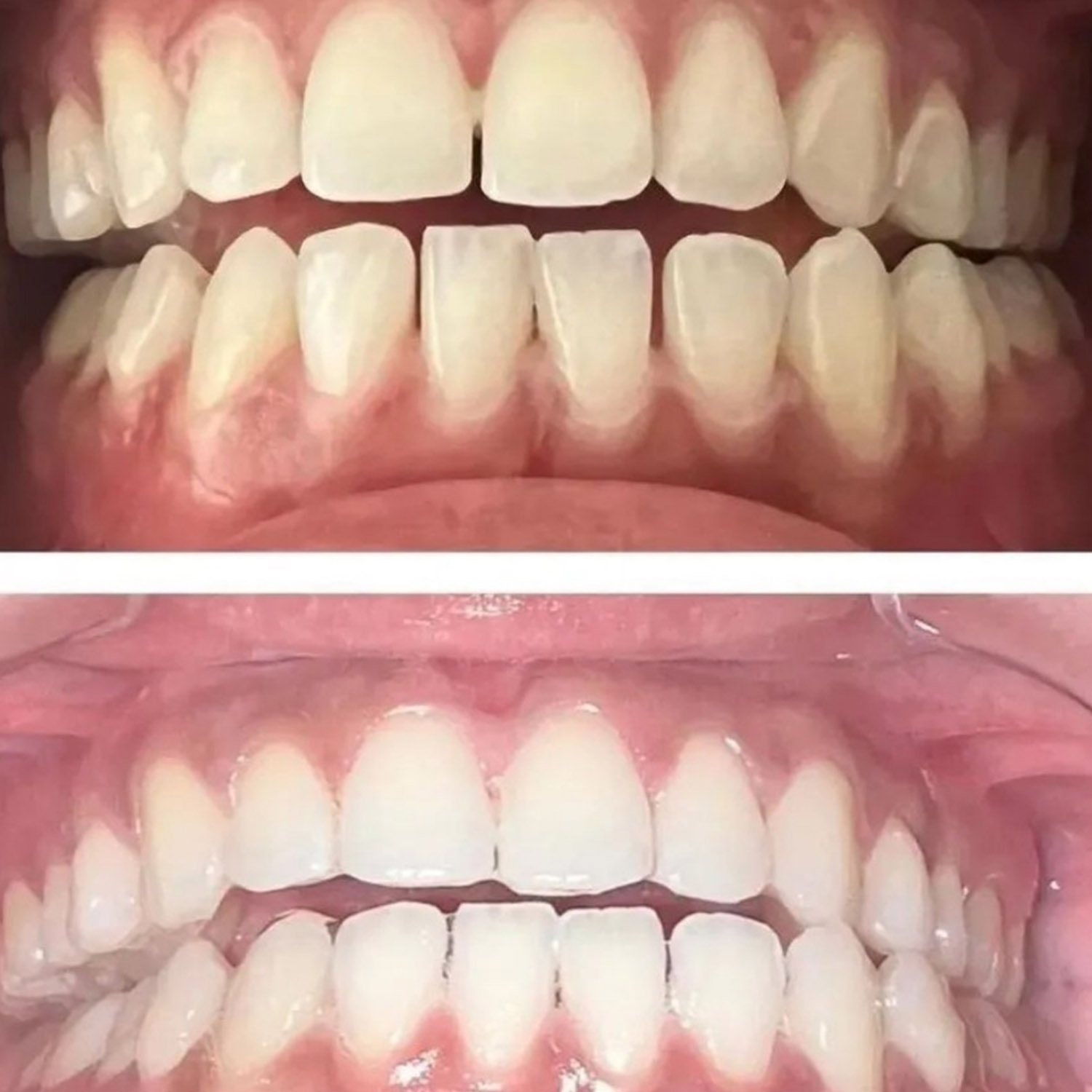 Teeth Whitening Treatment before & After at Rejuvenate Laser & Skin Clinic