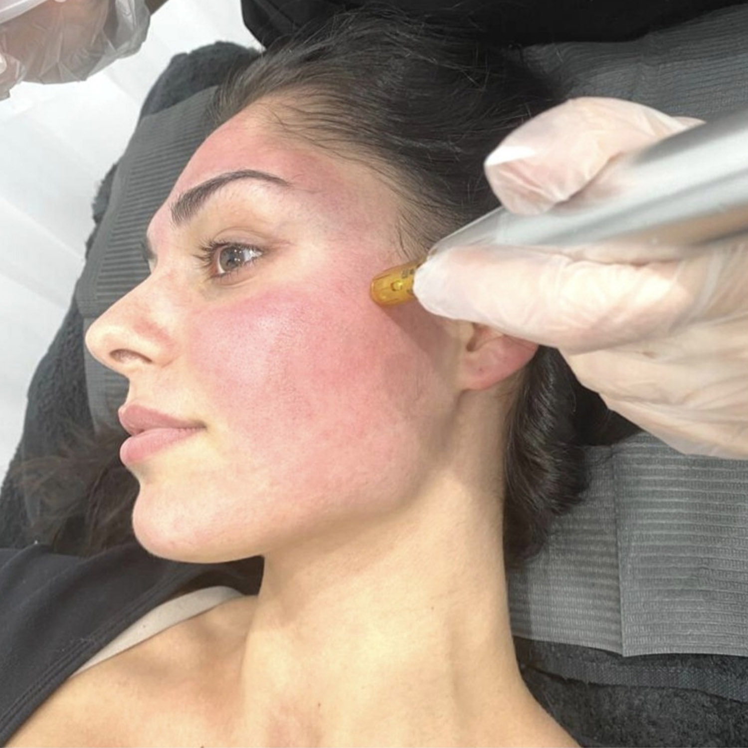 Dermapen & Skin Needling using modern equipment and technique at Rejuvenate Laser & Skin Clinic