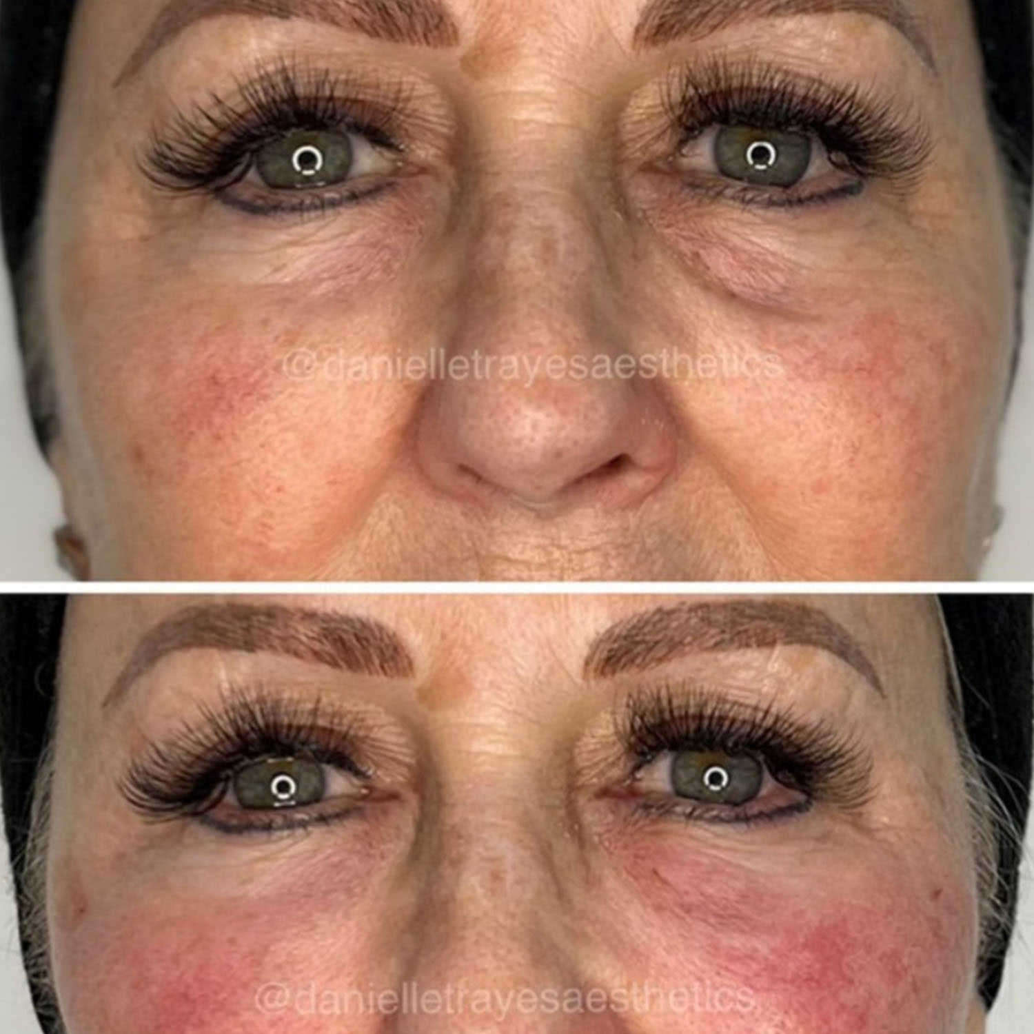 Eye Treatments using modern equipment and technique at Rejuvenate Laser & Skin Clinic