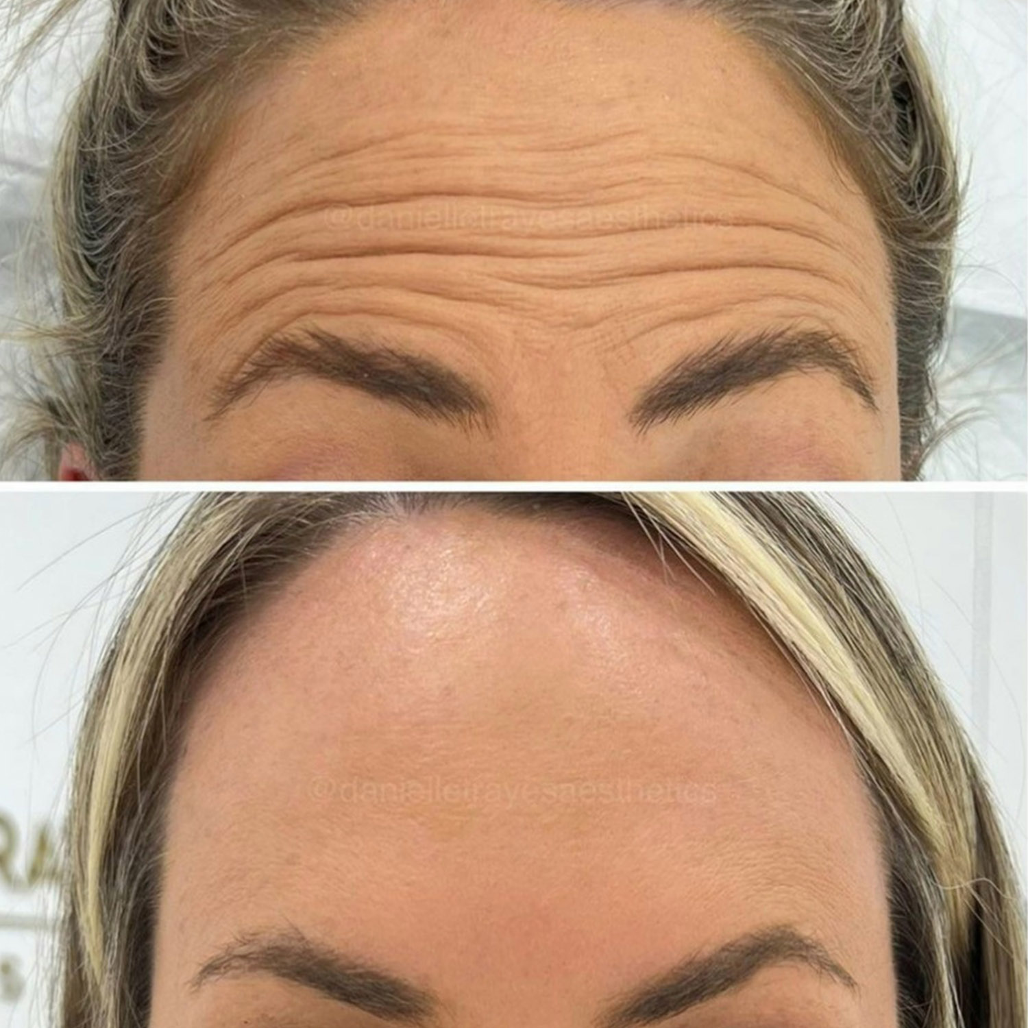 Anti Wrinkle Injections and Dermal Fillers Treatment using cutting edge products and technique at Rejuvenate Laser & Skin Clinic
